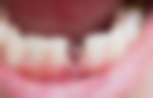 2026年重庆半口种植牙价格及技术