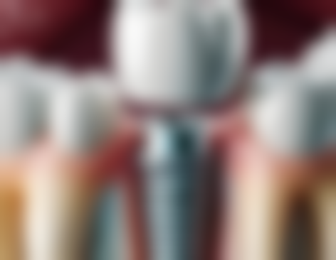 东莞洁丽口腔核心项目