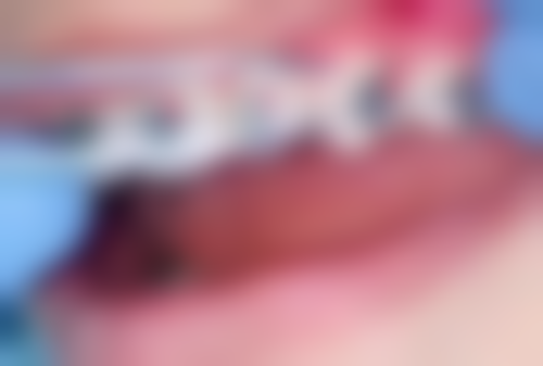 青岛市口腔医院口腔种植科怎么预约？