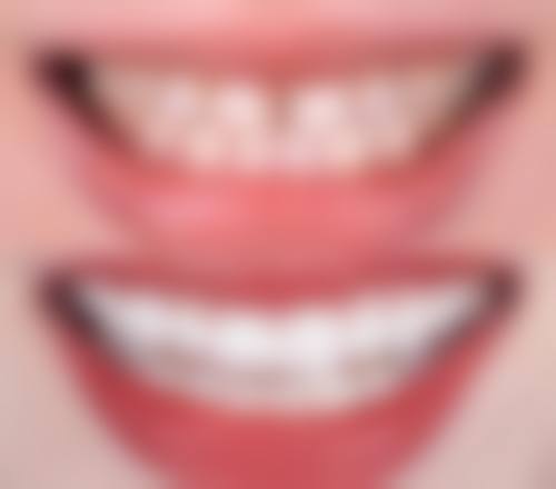 青岛大学附属医院口腔修复科怎么预约?