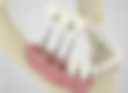 广东珠海锆齿口腔实例参考